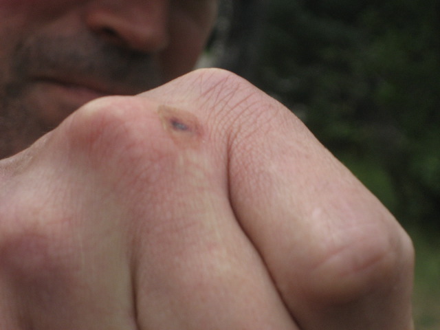 Mysterious damage to Mark's hand