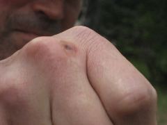 Mysterious damage to Mark's hand